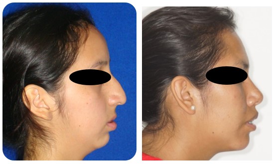 retrognatismo_mandibular